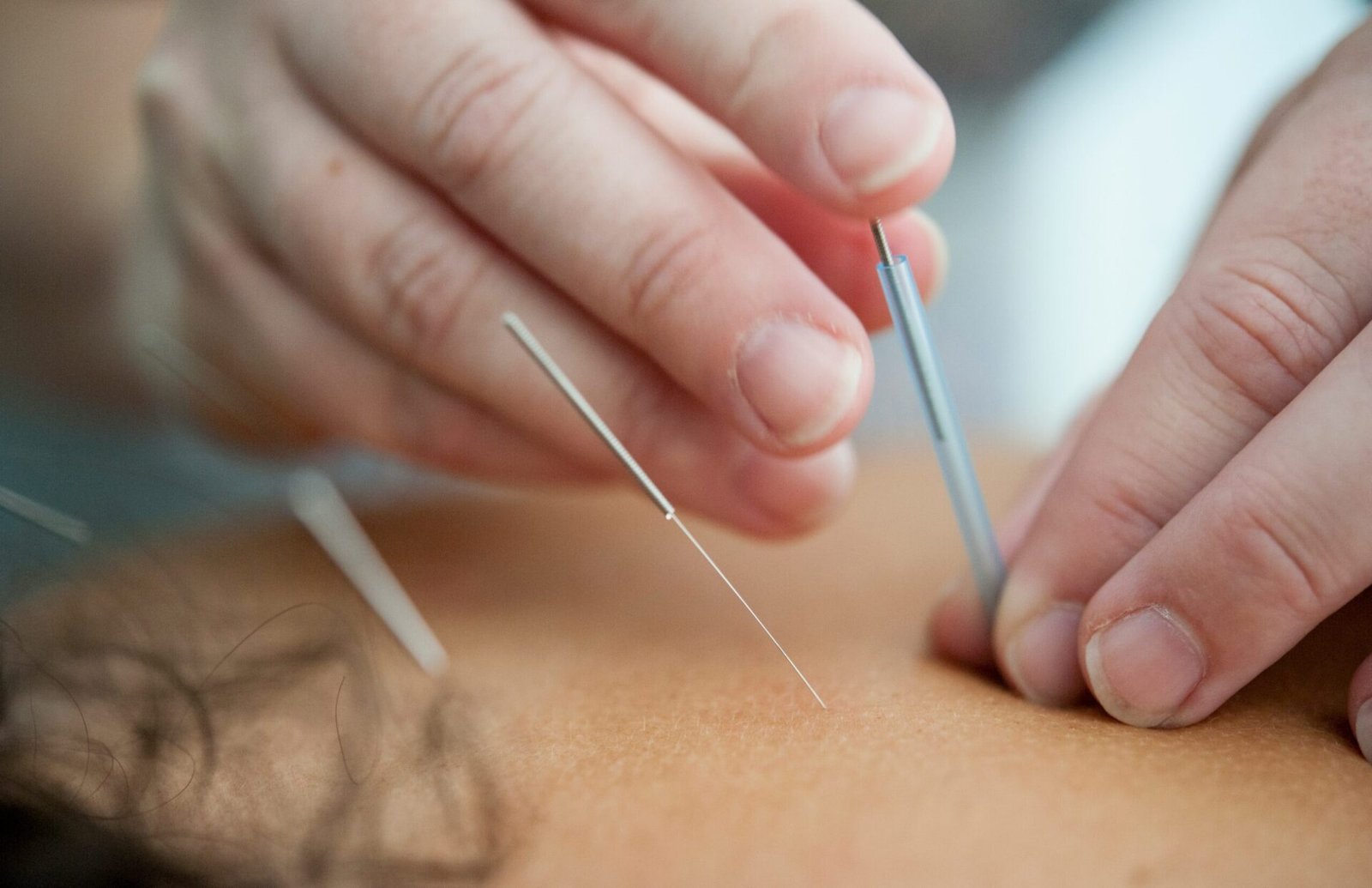 A therapist performing acupuncture on a patient to relieve pain.